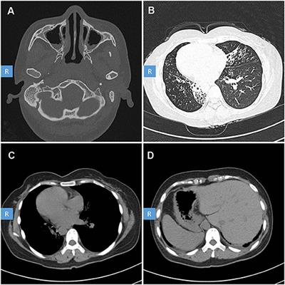 Case Report: Identification of a Novel ODAD3 Variant in a Patient With Primary Ciliary Dyskinesia